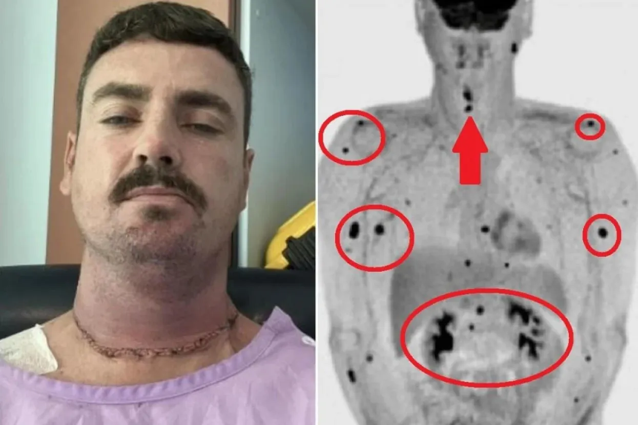 Selfie nakon operacije i snimka PET CT-a koja pokazuje da su metastaze zahvatile cijelo tijelo